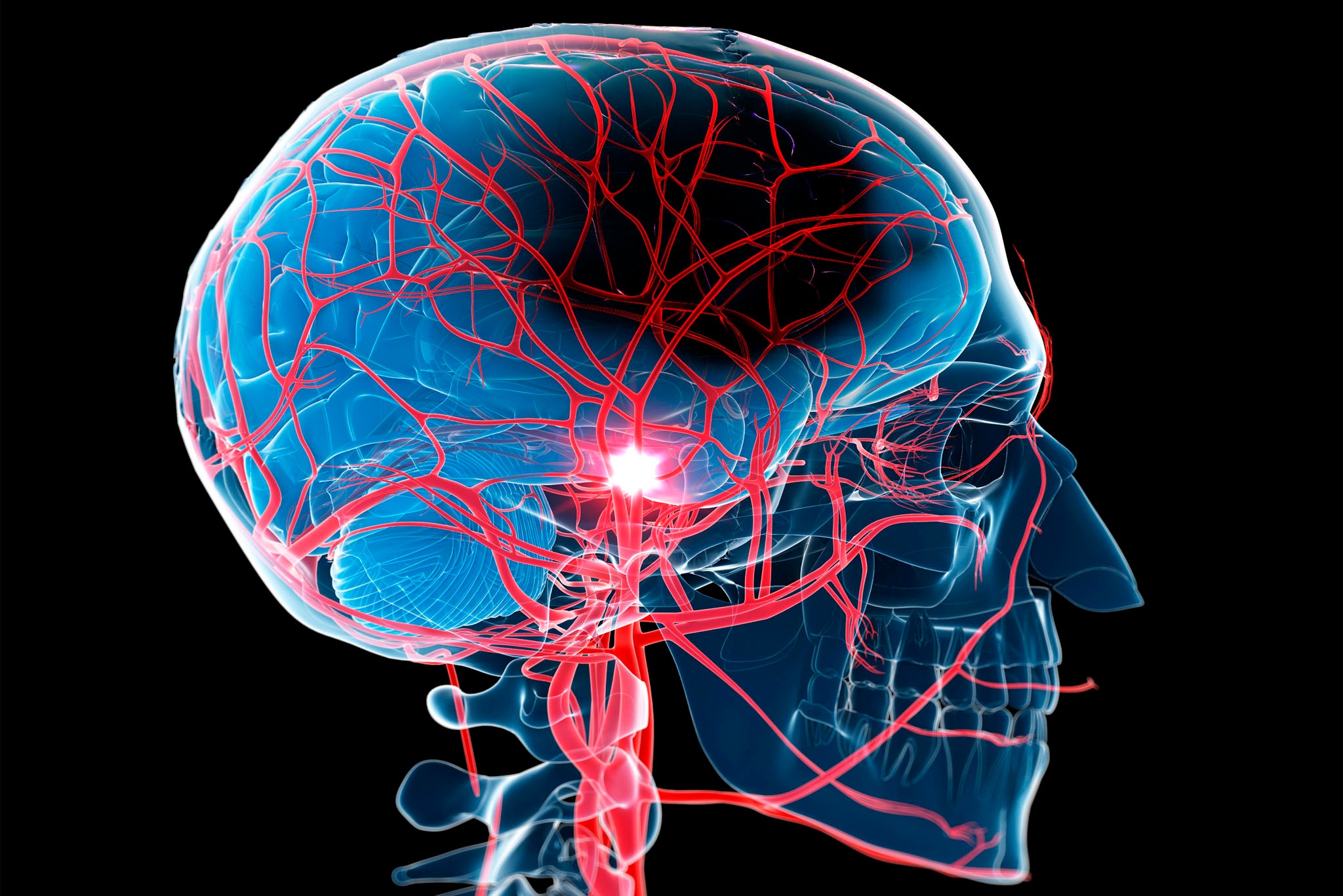 Stroke