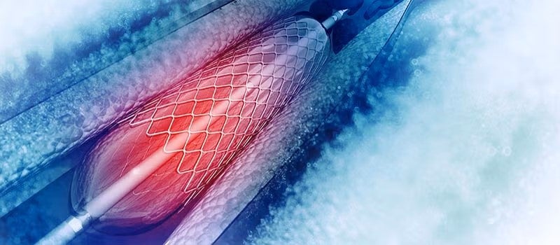 Radial Access for Catheterization