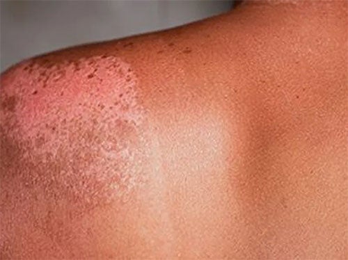 Most Dermatology Patients Like 'Telehealth' Visits: Survey
