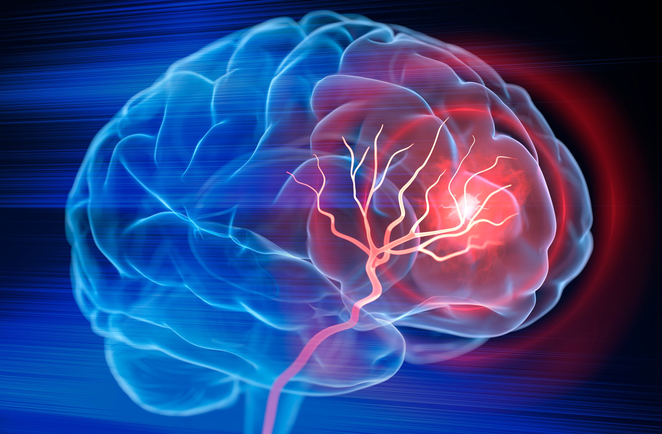 Don't Let Stroke Take You by Surprise