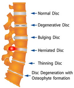 Degenerative Disk Disease