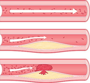 Atherosclerosis diagram