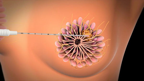 EnVisio breast implantation